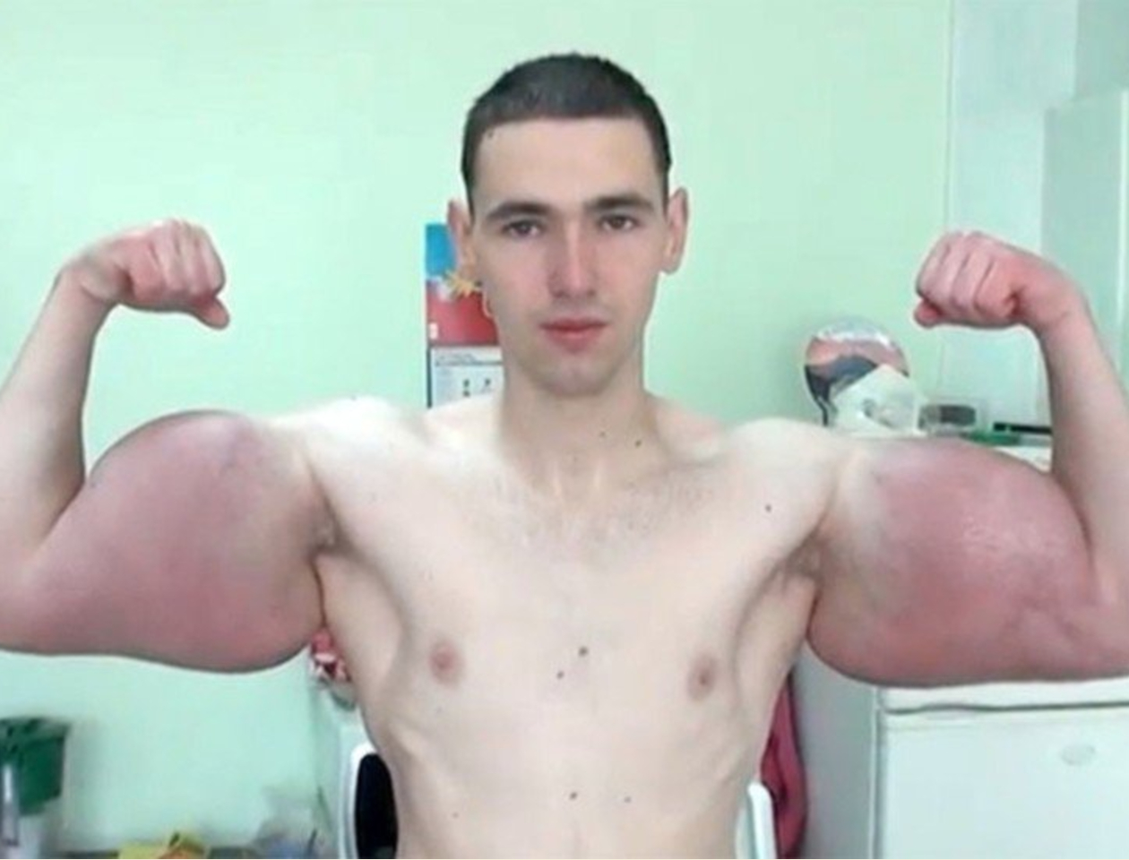 WATCH: 'Russian Popeye' Hospitalized as His 'Bazooka Arms' Begin to Rot; Influencer Faces Amputation Risk